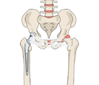 Hip cemented hemiarthroplasty bone full Icons, Symbols, Pictures, and Images