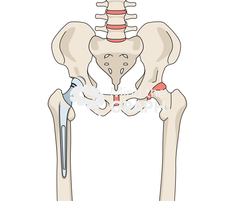 Hip cemented hemiarthroplasty bone full Icons, Symbols, Pictures, and Images