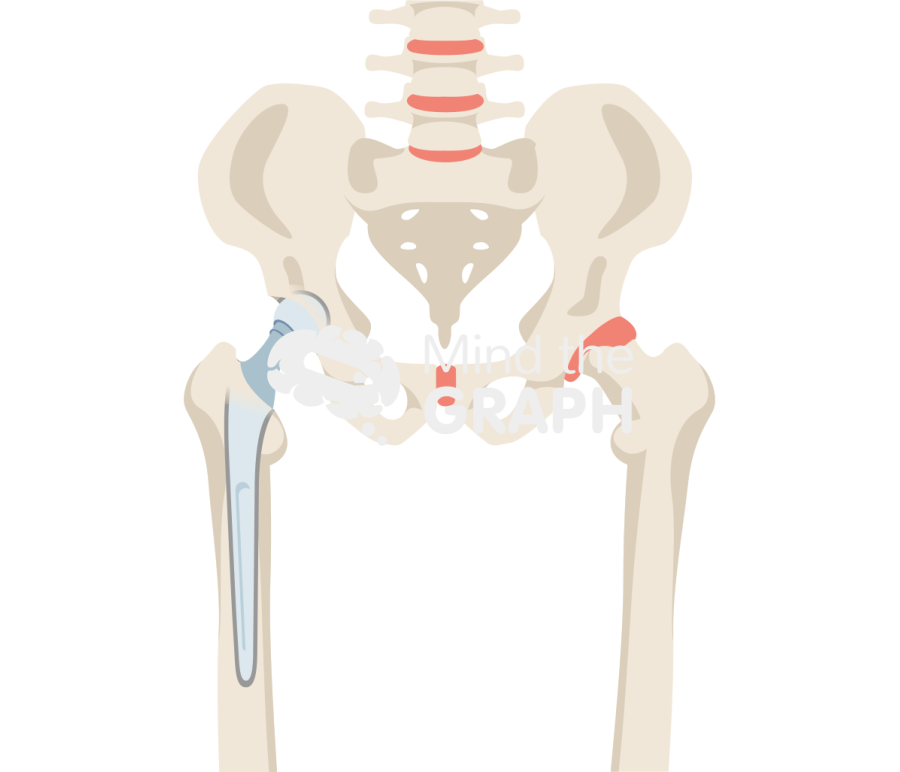 Hip cemented hemiarthroplasty bone full Icons, Symbols, Pictures, and Images