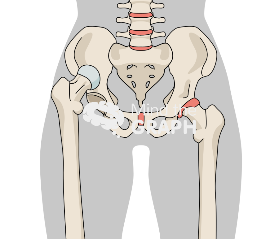 Hip dysplasia body Icons, Symbols, Pictures, and Images
