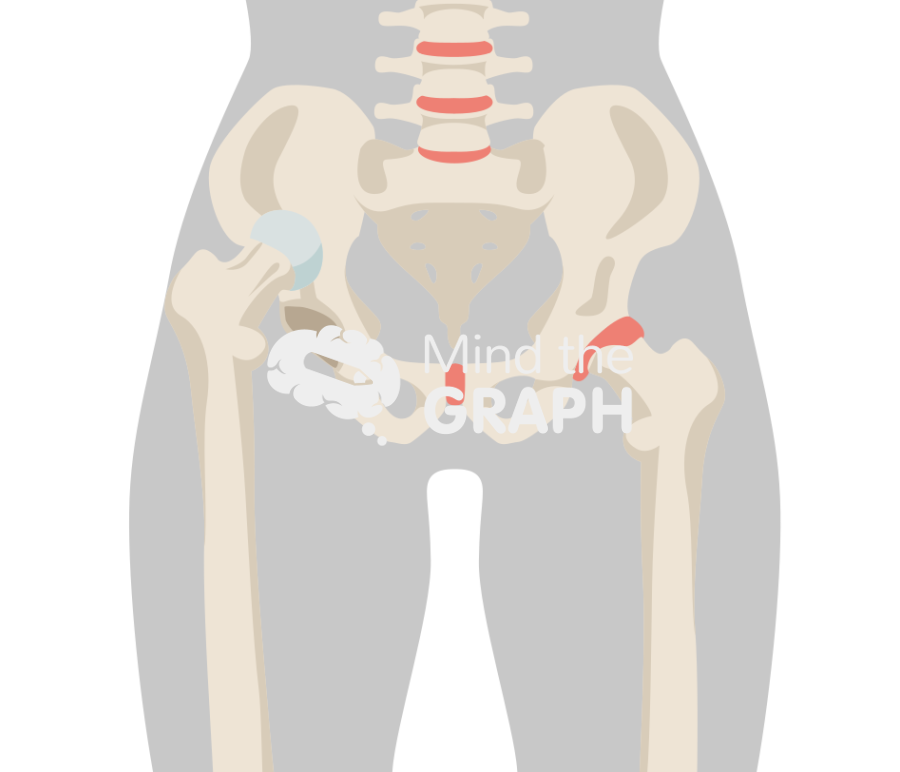 Hip dysplasia body Icons, Symbols, Pictures, and Images