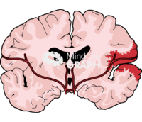 Human brain blood injury front cut 1 Icons, Symbols, Pictures, and Images