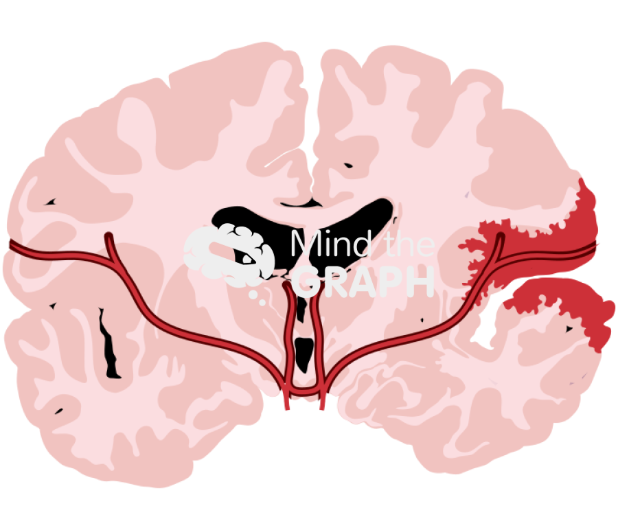 Human brain blood injury front cut 1 Icons, Symbols, Pictures, and Images