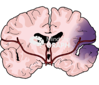 Human brain blood injury front cut 2 Icons, Symbols, Pictures, and Images