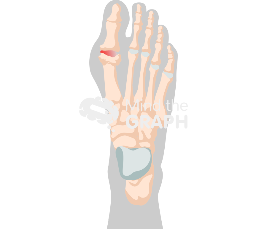 Human foot bones gouty arthritis shape superior Icons, Symbols, Pictures, and Images