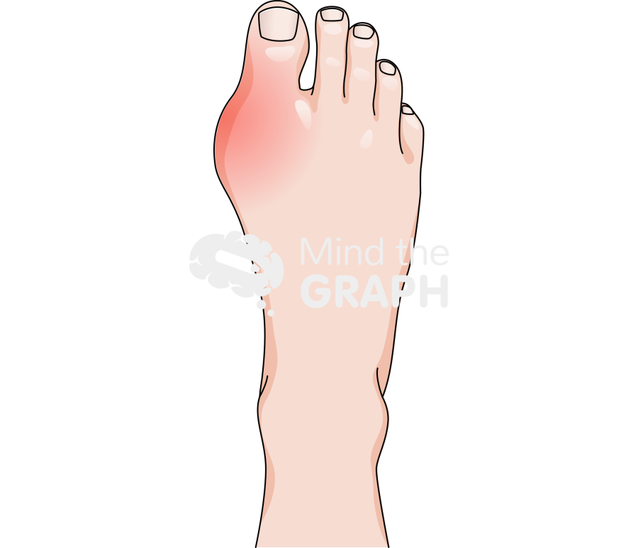 Human foot gouty arthritis superior Icons, Symbols, Pictures, and Images