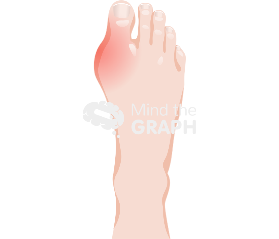 Human foot gouty arthritis superior Icons, Symbols, Pictures, and Images