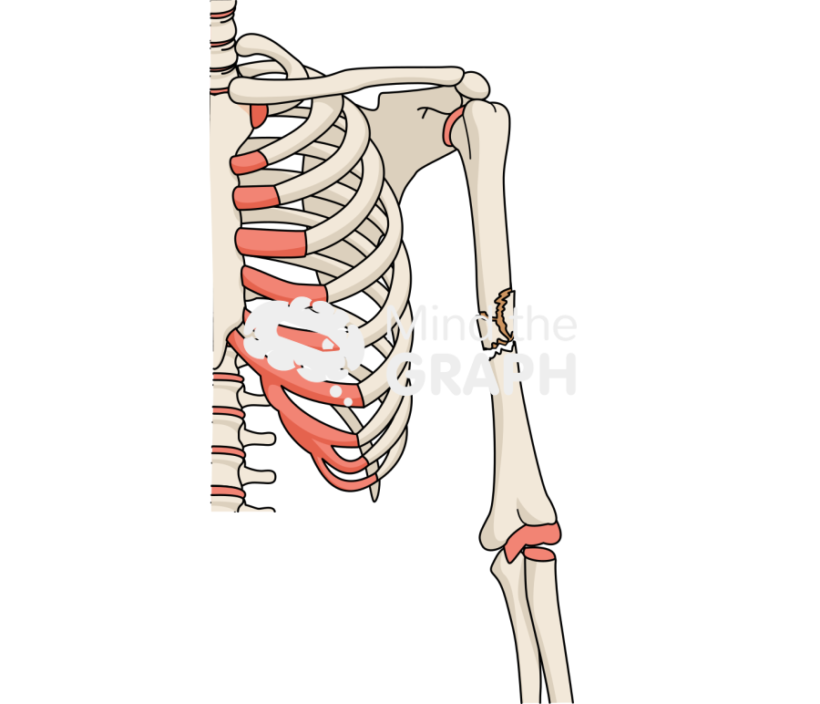 Humerus fracture 2 Icons, Symbols, Pictures, and Images