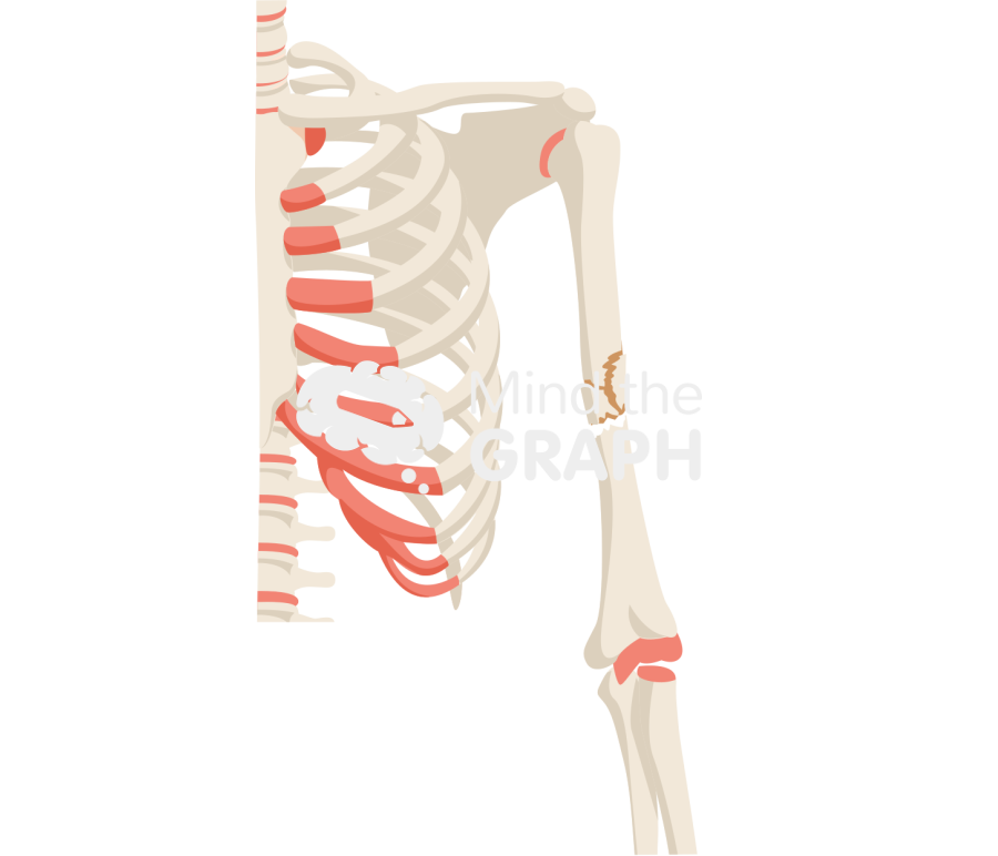 Humerus fracture 2 Icons, Symbols, Pictures, and Images