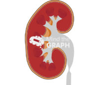Hydronephrosis kidney mild - Edit and Customize Icons of Hydronephrosis kidney mild Hydronephrosis kidney mild Icons, Symbols, Pictures, and Images