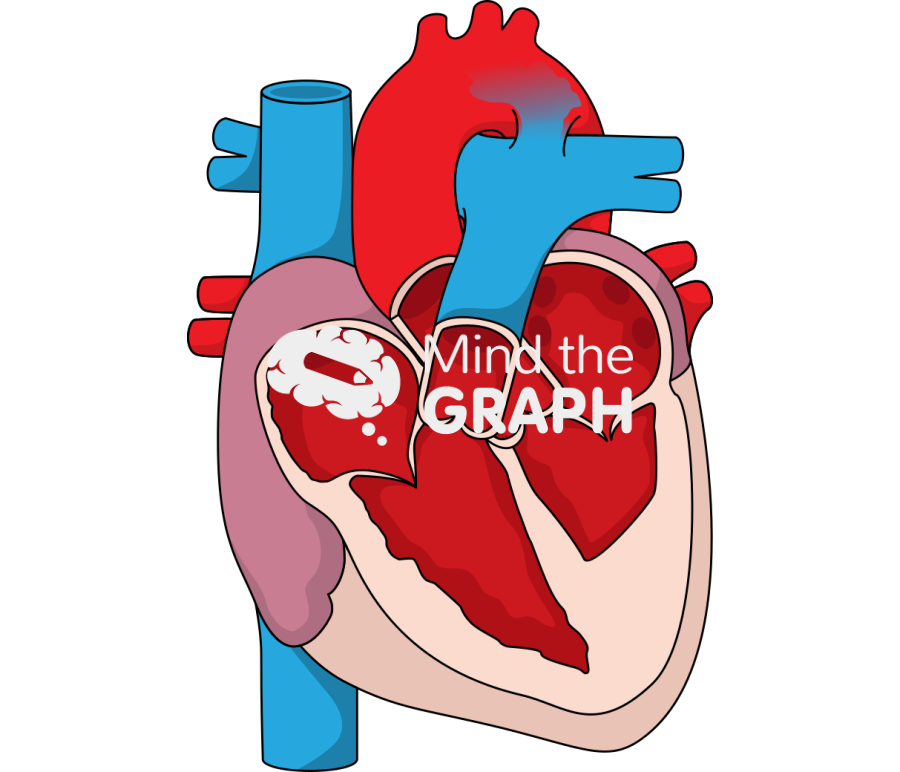 Hypoplastic left heart patent duct arteriosus reversal flow arch aorta Icons, Symbols, Pictures, and Images