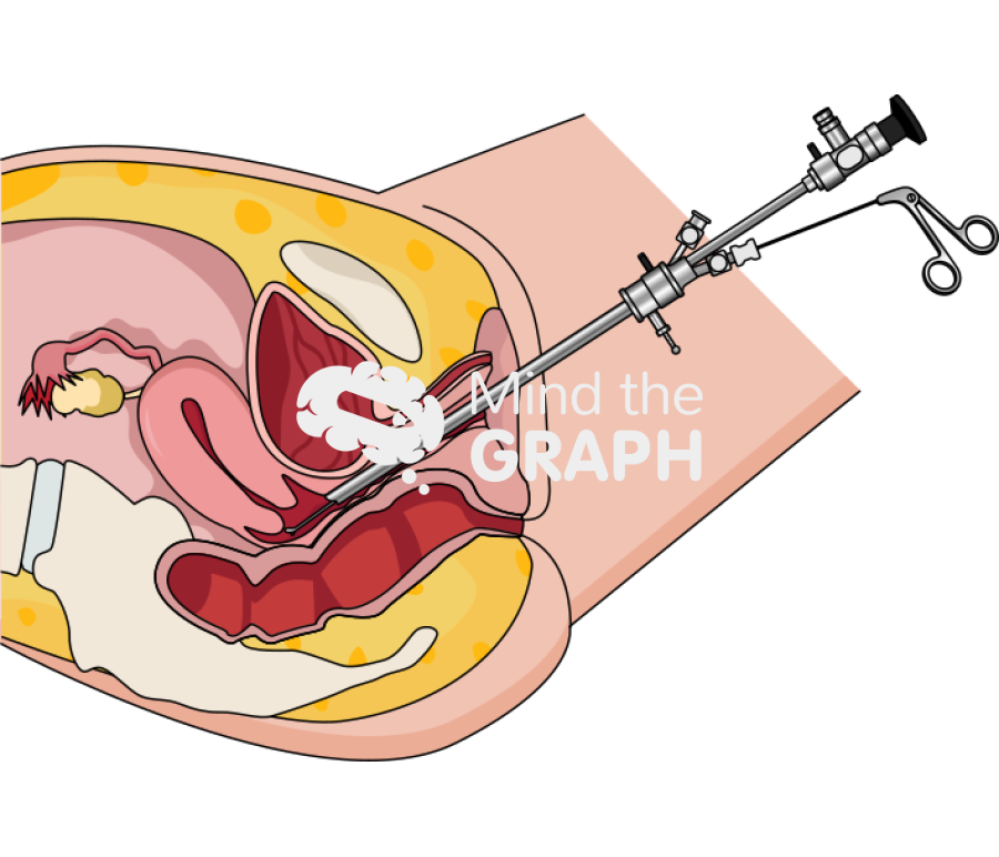 Hysteroscopy reproductive system longitudinal cut Icons, Symbols, Pictures, and Images