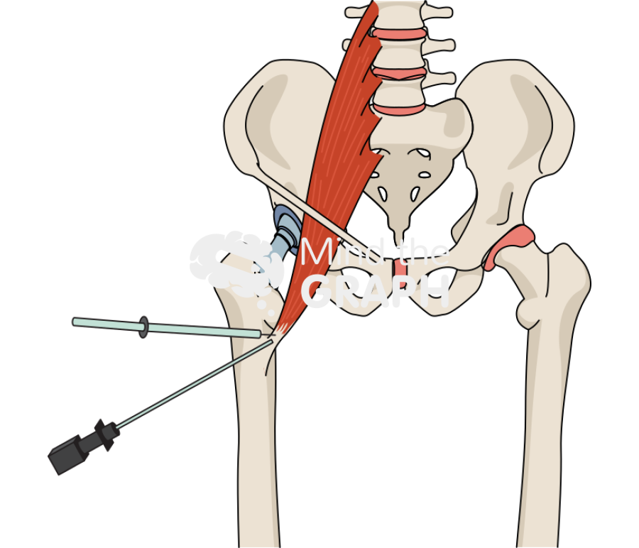 Iliopsoas arthroscopic release Icons, Symbols, Pictures, and Images
