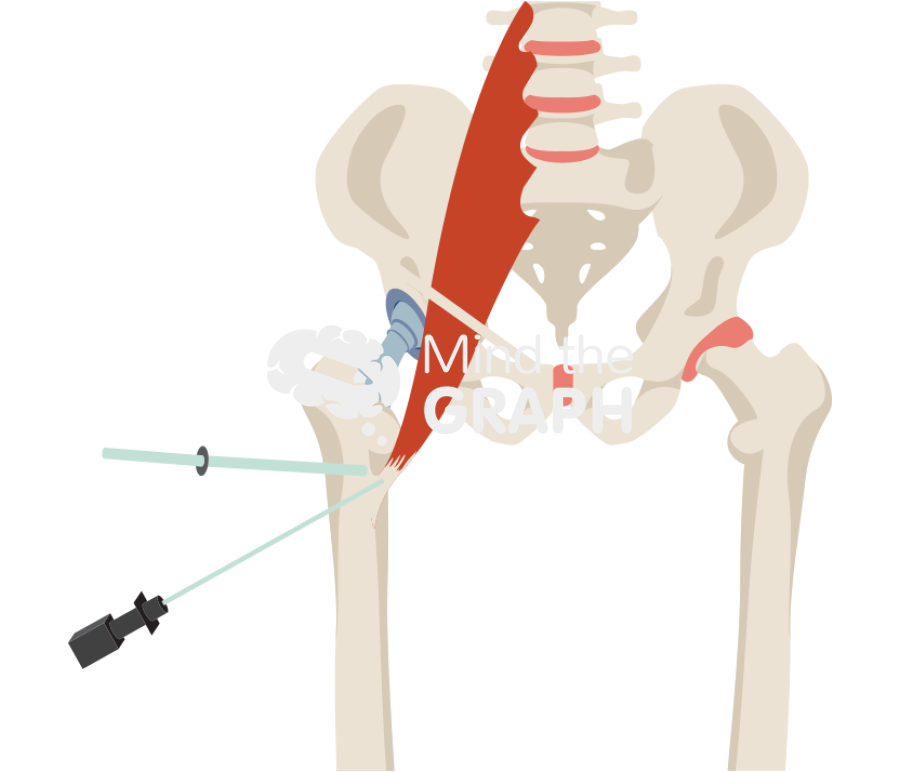 Iliopsoas arthroscopic release Icons, Symbols, Pictures, and Images