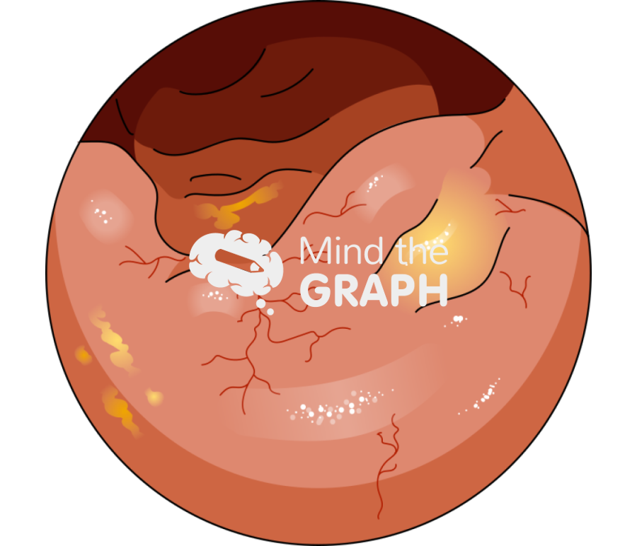 Inflammed ileum zoom Icons, Symbols, Pictures, and Images