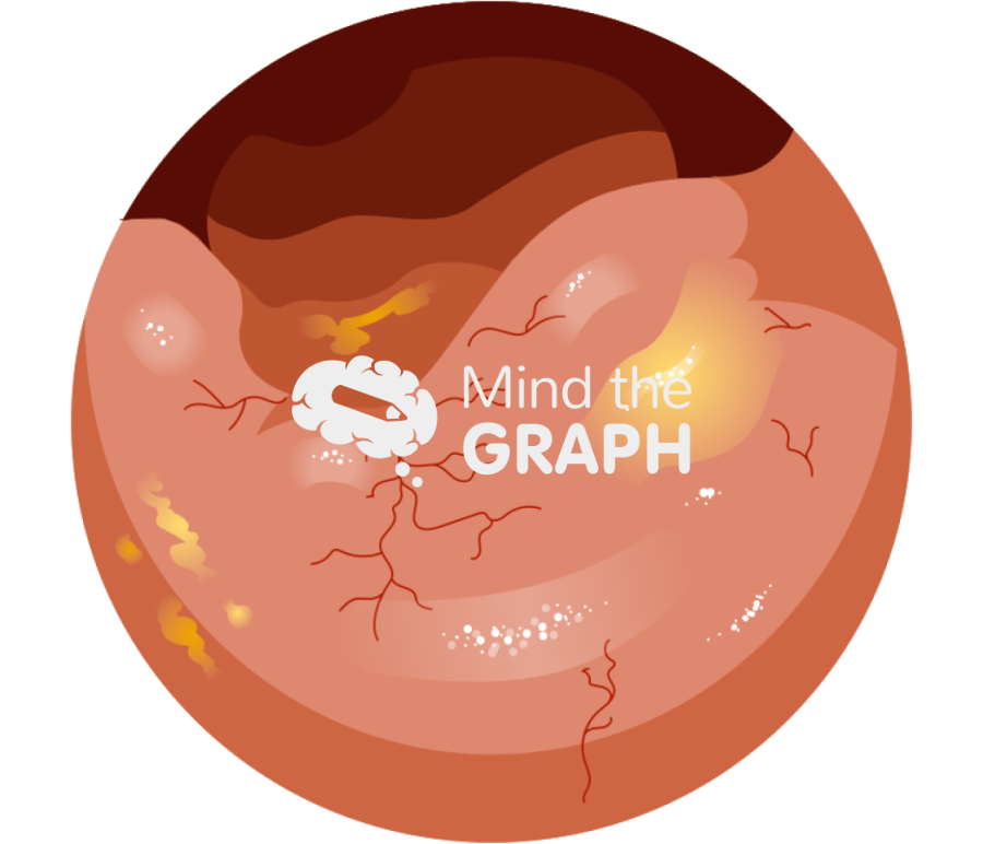 Inflammed ileum zoom Icons, Symbols, Pictures, and Images