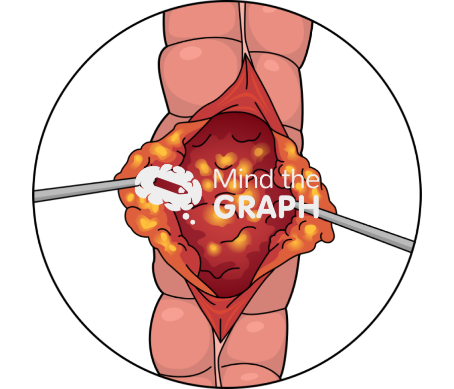 Intestine disease zoom Icons, Symbols, Pictures, and Images