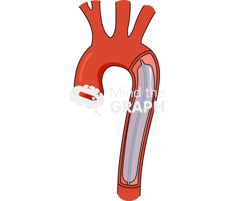 Intraaortic balloon pump cardiogenic shock support Icons, Symbols, Pictures, and Images