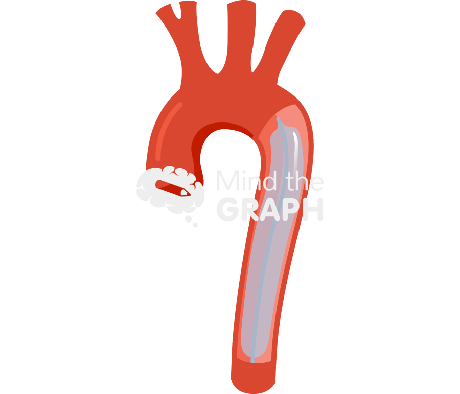 Intraaortic balloon pump cardiogenic shock support Icons, Symbols, Pictures, and Images