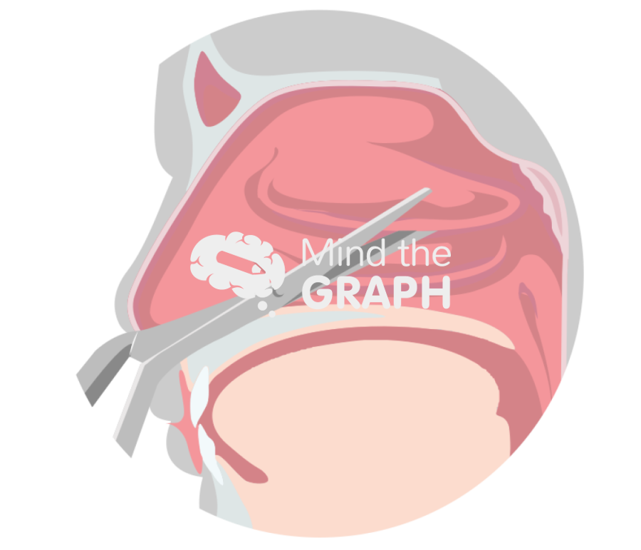 Intranasal surgery lower turbinate Icons, Symbols, Pictures, and Images