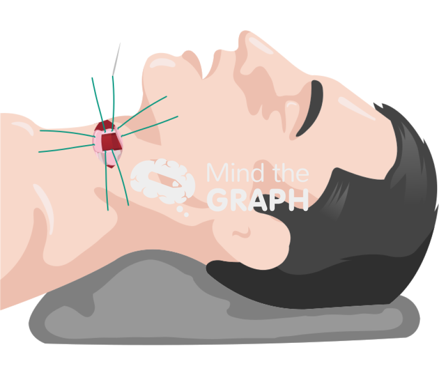 Inverted u incision tracheostomy suture Icons, Symbols, Pictures, and Images
