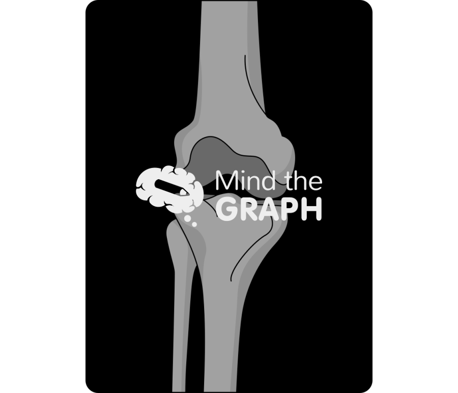 Isolated medial knee degenerative joint disease x ray Icons, Symbols, Pictures, and Images