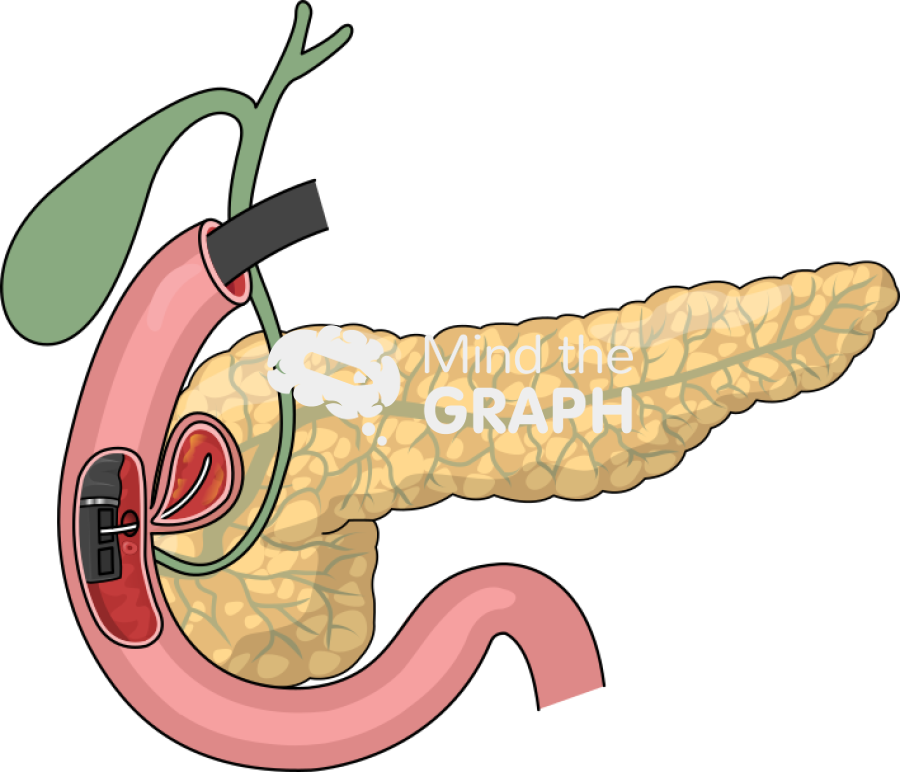 Juxta ampullary diverticulum endoscopic treatment Icons, Symbols, Pictures, and Images
