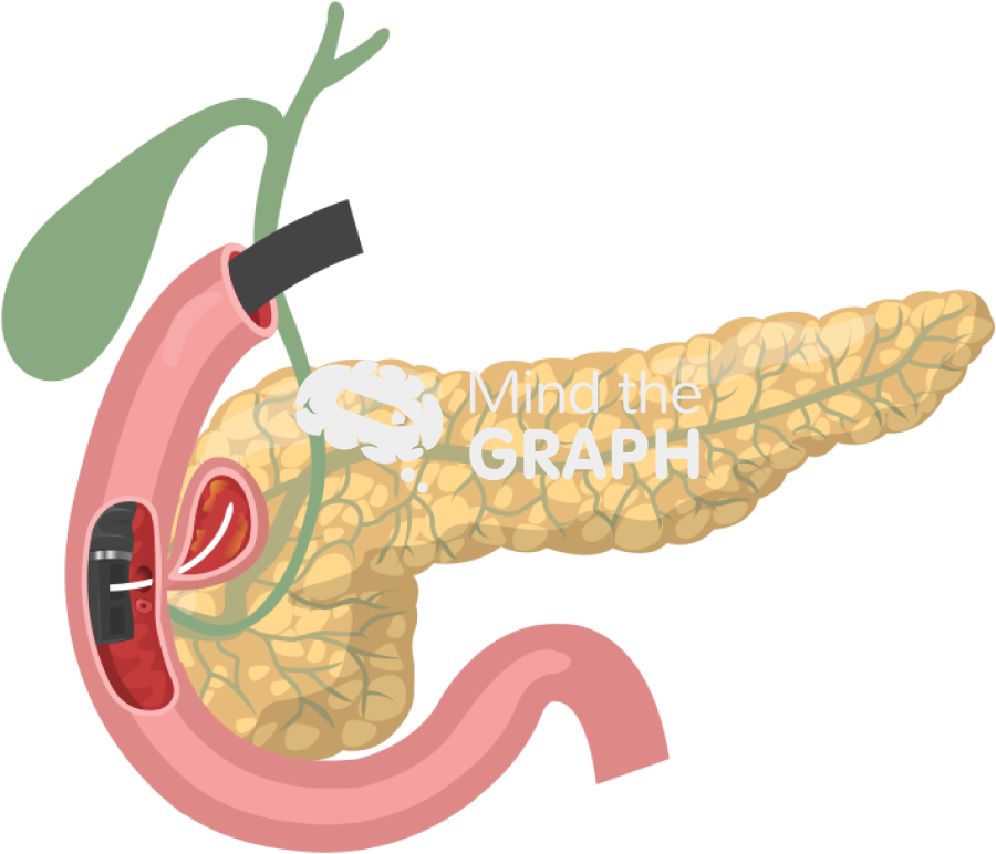Juxta ampullary diverticulum endoscopic treatment Icons, Symbols, Pictures, and Images