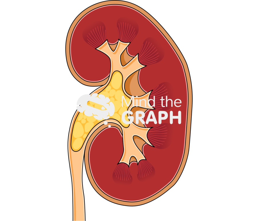 Kidney staghorn calculus Icons, Symbols, Pictures, and Images