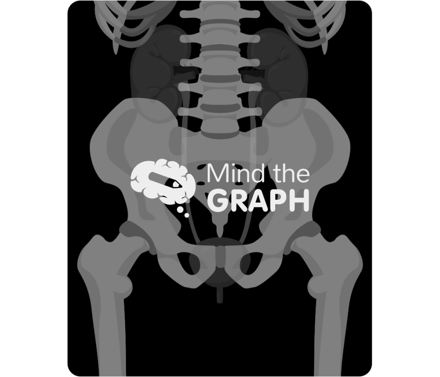 Kidney stone x ray Icons, Symbols, Pictures, and Images