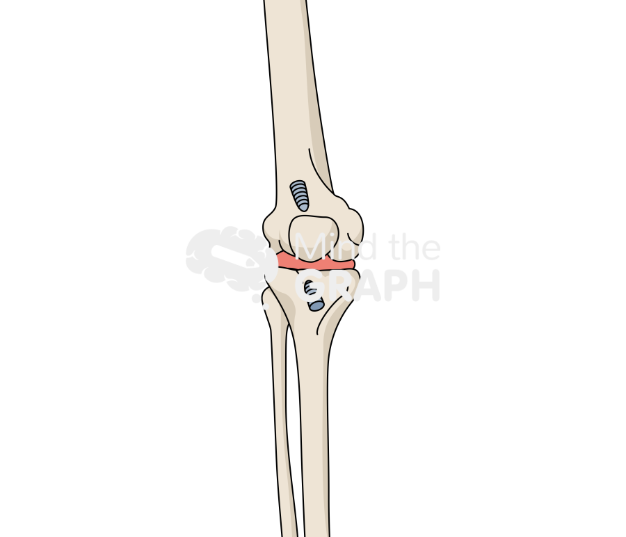 Knee arthritis anterior cruciate ligament screws Icons, Symbols, Pictures, and Images