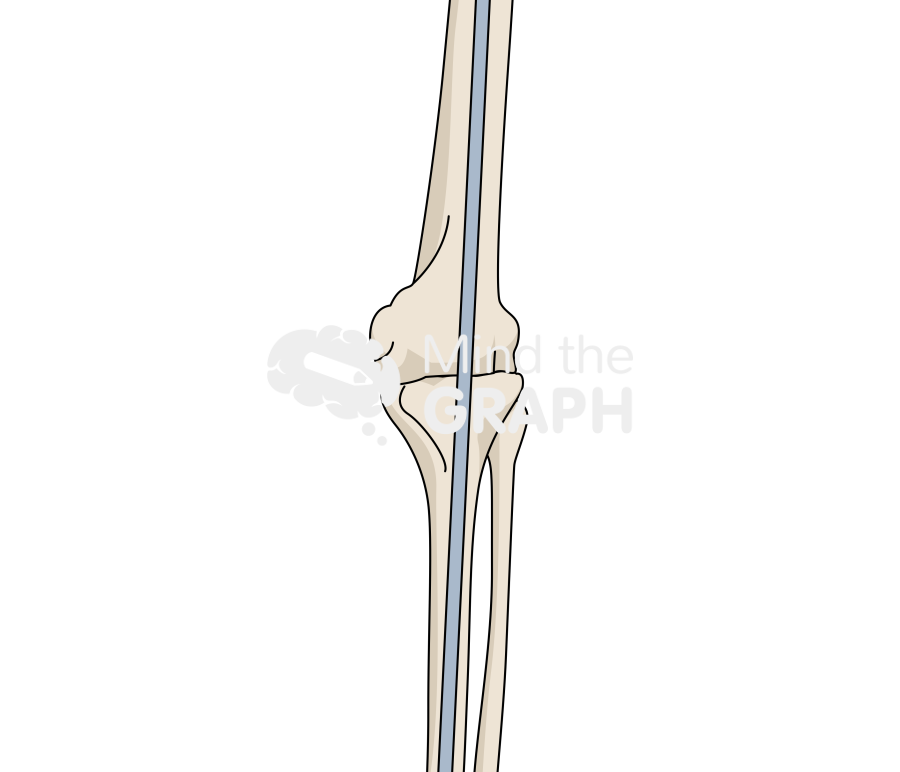 Knee arthrodesis Icons, Symbols, Pictures, and Images