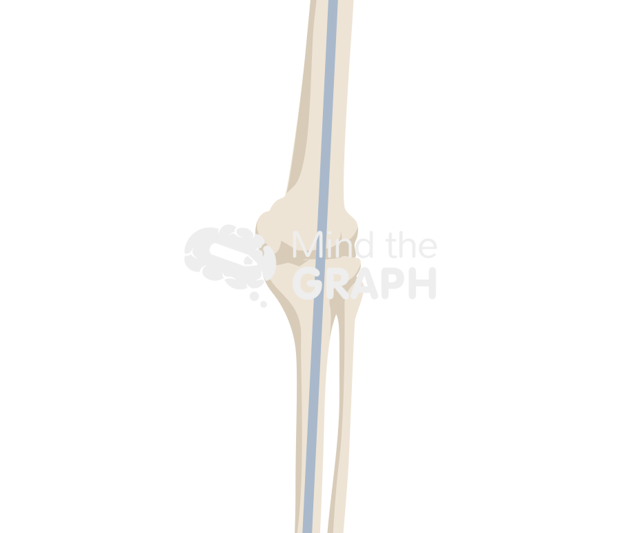 Knee arthrodesis Icons, Symbols, Pictures, and Images