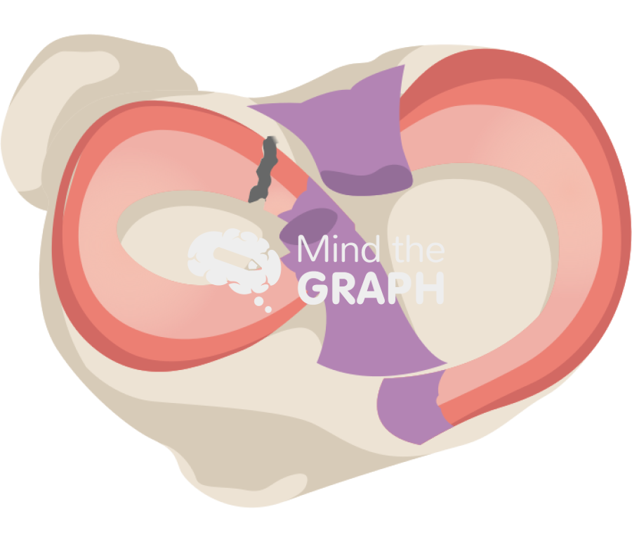 Lateral meniscus root tear Icons, Symbols, Pictures, and Images