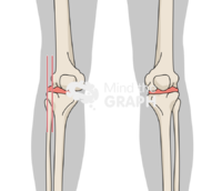Lateral tibiofemoral subluxation body Icons, Symbols, Pictures, and Images