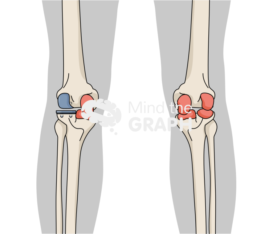 Lateral unicondylar knee arthroplasty fixed bearing anterior posterior body Icons, Symbols, Pictures, and Images