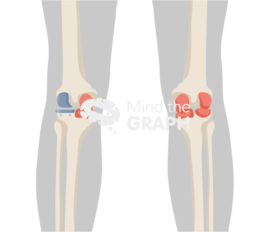 Lateral unicondylar knee arthroplasty fixed bearing anterior posterior body Icons, Symbols, Pictures, and Images