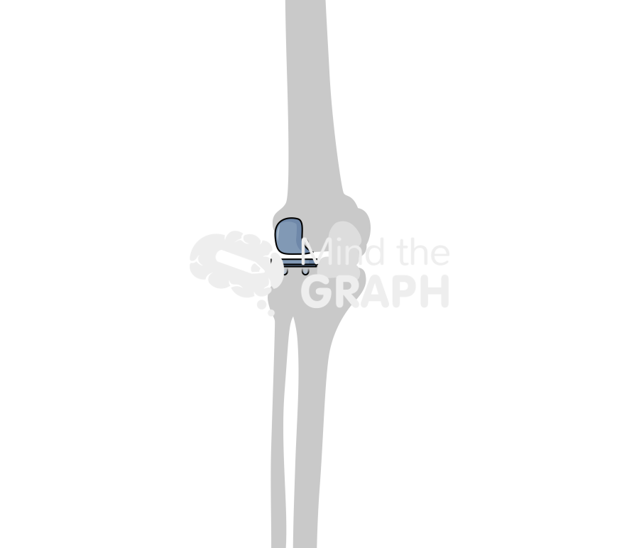 Lateral unicondylar knee arthroplasty fixed bearing anterior posterior bone Icons, Symbols, Pictures, and Images