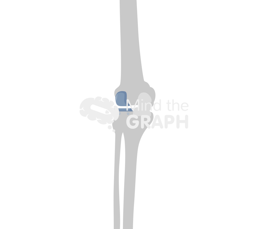 Lateral unicondylar knee arthroplasty fixed bearing anterior posterior bone Icons, Symbols, Pictures, and Images