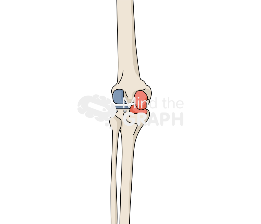 Lateral unicondylar knee arthroplasty fixed bearing anterior posterior bone full Icons, Symbols, Pictures, and Images