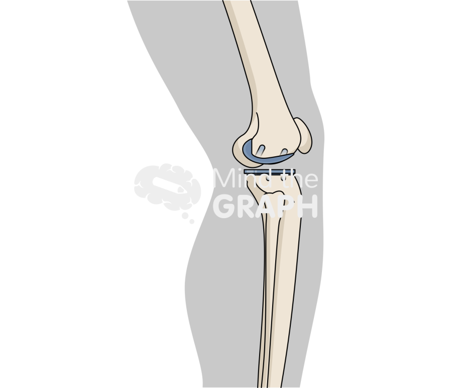 Lateral unicondylar knee arthroplasty fixed bearing body Icons, Symbols, Pictures, and Images