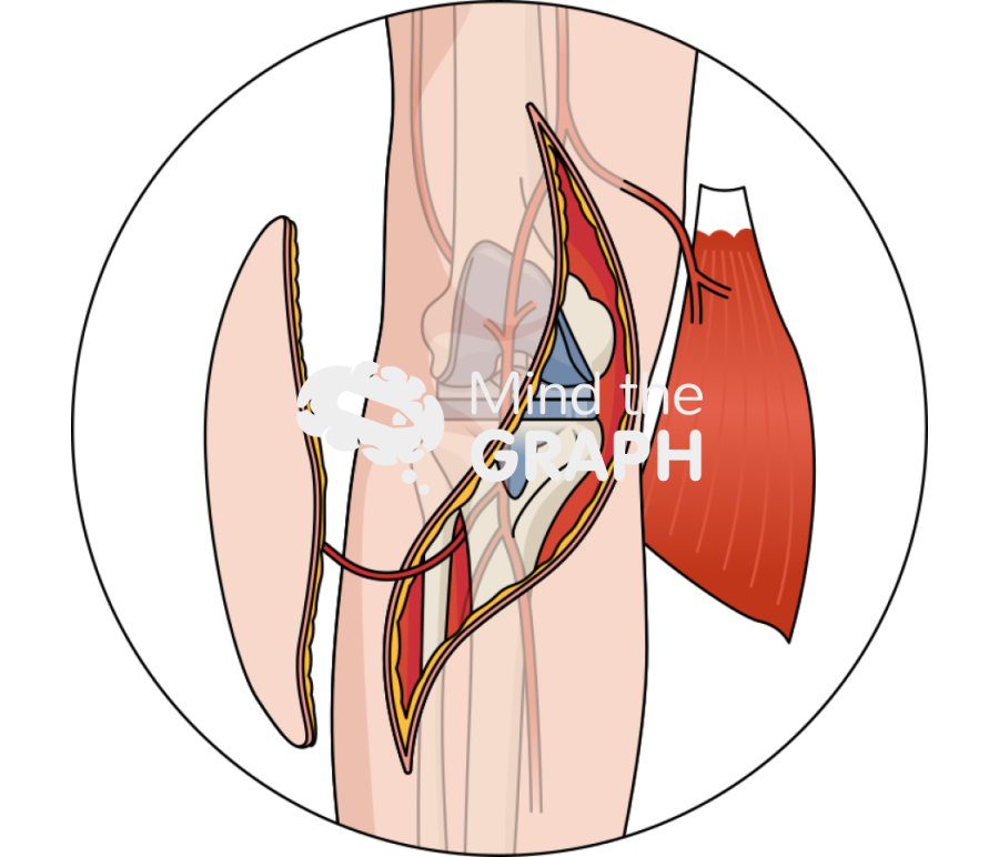 Latissimus dorsi flap total knee arthroplasty zoom Icons, Symbols, Pictures, and Images