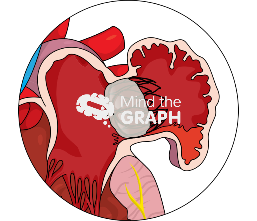 Left atrial appendage pdl edge leak zoom Icons, Symbols, Pictures, and Images