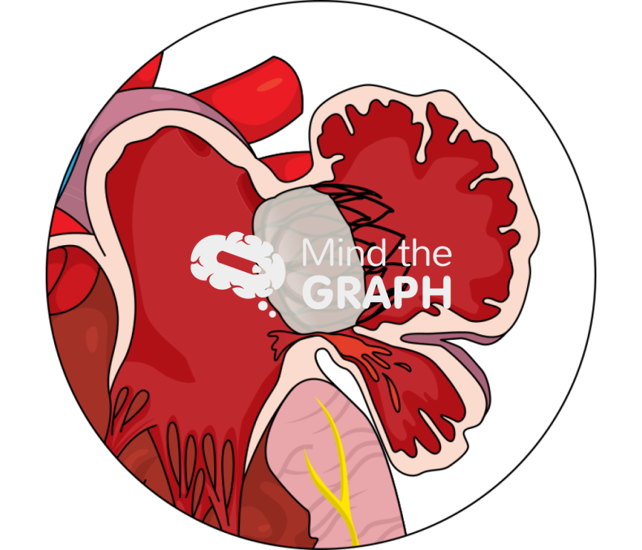 Left atrial appendage pdl uncovered lobe zoom Icons, Symbols, Pictures, and Images