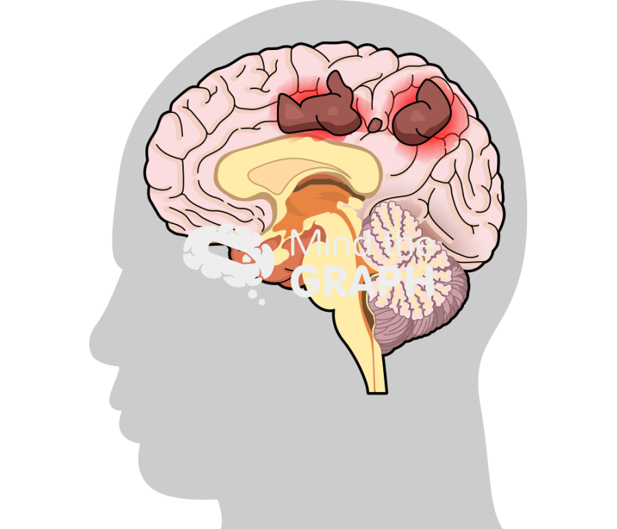 Leukoencephalopathy progressivel multifocal brain 1 Icons, Symbols, Pictures, and Images