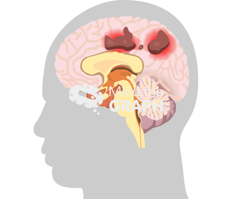 Leukoencephalopathy progressivel multifocal brain 1 Icons, Symbols, Pictures, and Images