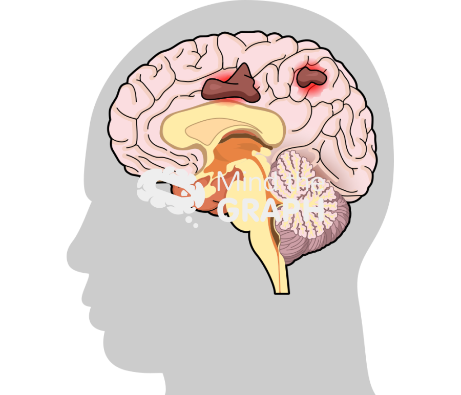 Leukoencephalopathy progressivel multifocal brain 2 Icons, Symbols, Pictures, and Images