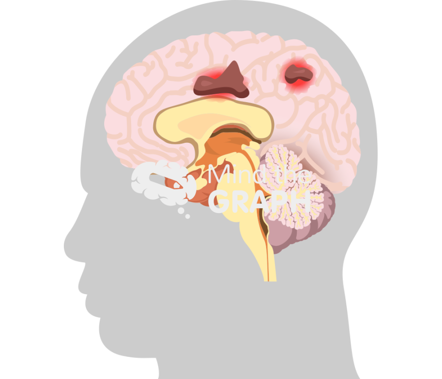 Leukoencephalopathy progressivel multifocal brain 2 Icons, Symbols, Pictures, and Images
