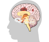 Leukoencephalopathy progressivel multifocal brain 3 Icons, Symbols, Pictures, and Images