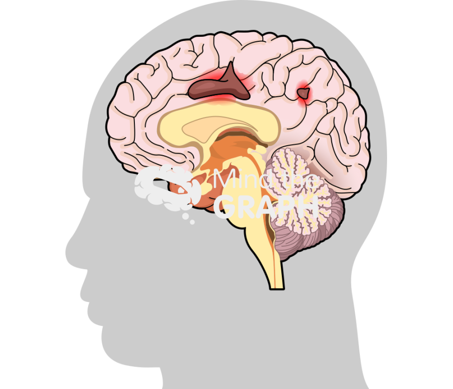 Leukoencephalopathy progressivel multifocal brain 3 Icons, Symbols, Pictures, and Images